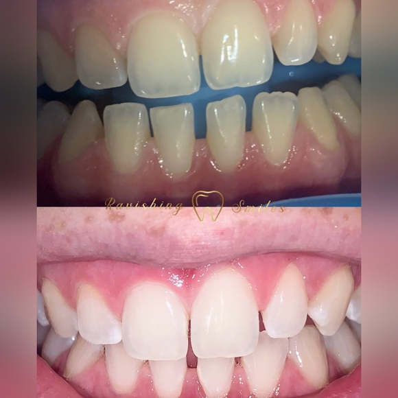 Teeth Whitening Pen. 16% Hydrogen Peroxide. No LED Accelerator Light needed. - Picture 5 of 7